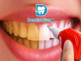 هزینه سفید کردن دندان در مطب دندانپزشکی