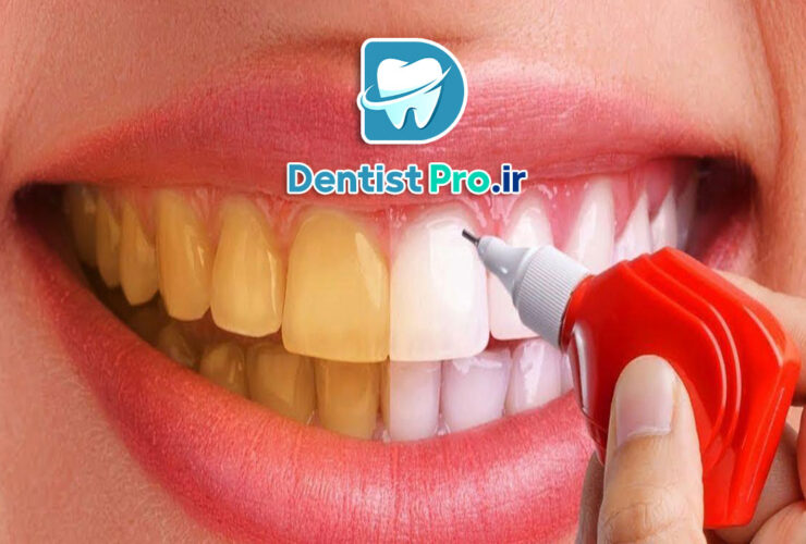 هزینه سفید کردن دندان در مطب دندانپزشکی 42 هزینه سفید کردن دندان در مطب دندانپزشکی