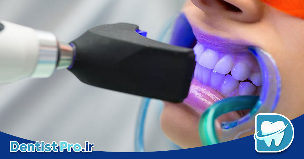 هزینه سفید کردن دندان در مطب دندانپزشکی