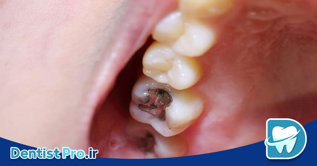 دوام پرکردگی دندان: بررسی جامع از زبان یک دندان‌پزشک
