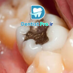 دوام پرکردگی دندان: بررسی جامع از زبان یک دندان‌پزشک