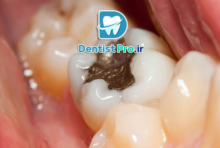 دوام پرکردگی دندان: بررسی جامع از زبان یک دندان‌پزشک