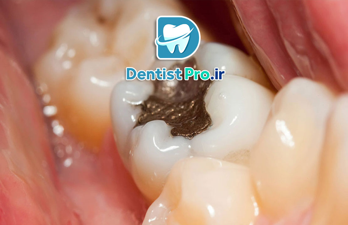 دوام پرکردگی دندان: بررسی جامع از زبان یک دندان‌پزشک
