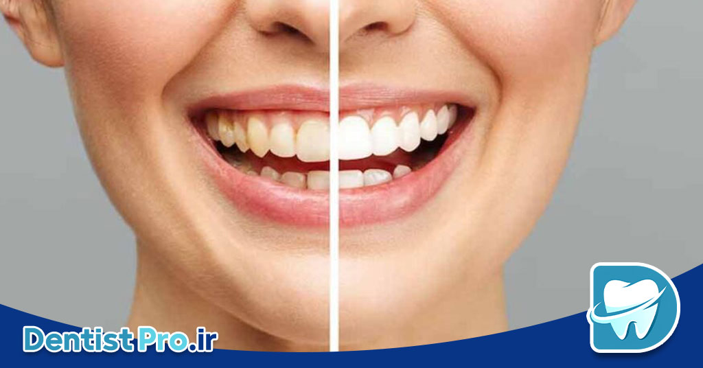 ماندگاری بلیچینگ دندان؛ راز داشتن لبخندی سفید و ماندگار 28 ماندگاری بلیچینگ دندان؛ راز داشتن لبخندی سفید و ماندگار