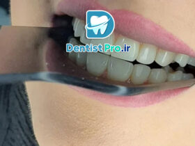 ماندگاری بلیچینگ دندان؛ راز داشتن لبخندی سفید و ماندگار