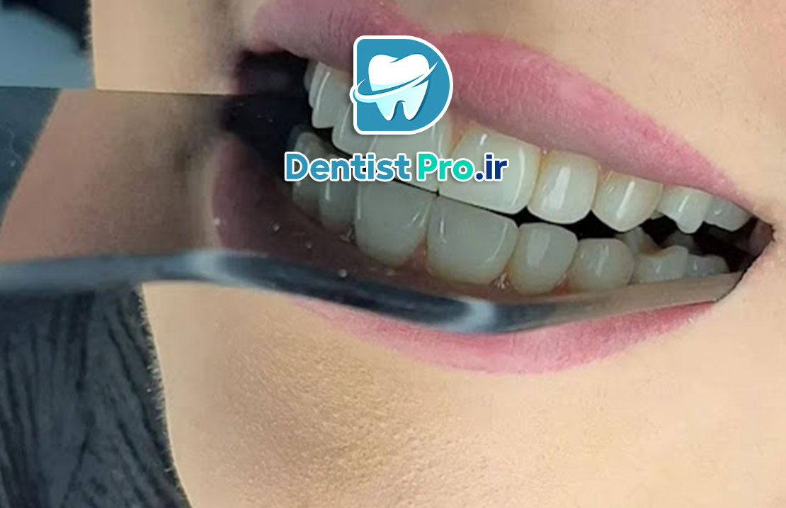 ماندگاری بلیچینگ دندان؛ راز داشتن لبخندی سفید و ماندگار 25 ماندگاری بلیچینگ دندان؛ راز داشتن لبخندی سفید و ماندگار