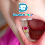 چرا باید پرکردن دندان کودکان با مواد بی ضرر انجام شود؟ راهنمای کامل والدین نگران!