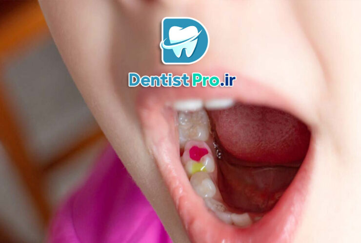چرا باید پرکردن دندان کودکان با مواد بی ضرر انجام شود؟ راهنمای کامل والدین نگران!