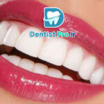 لبخند هالیوودی با قیمت مناسب