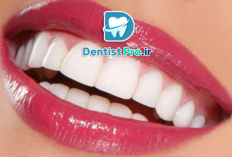 لبخند هالیوودی با قیمت مناسب