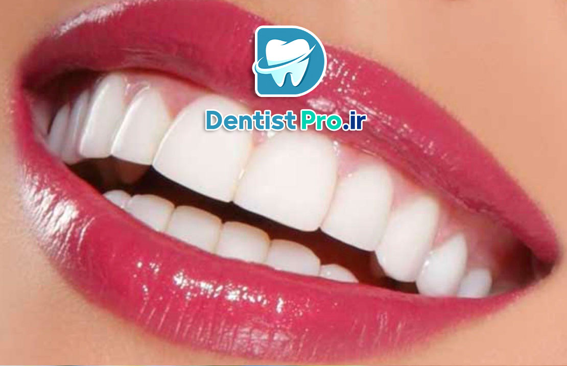 لبخند هالیوودی با قیمت مناسب 25 لبخند هالیوودی با قیمت مناسب