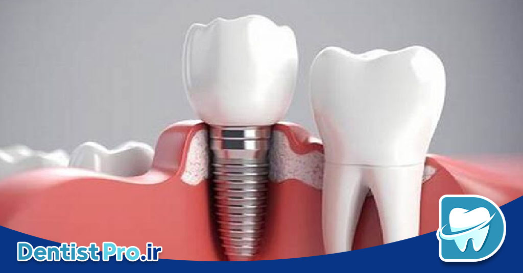ایمپلنت فوری بعد از کشیدن دندان
