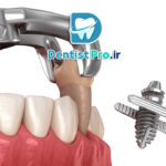 ایمپلنت فوری بعد از کشیدن دندان