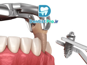 ایمپلنت فوری بعد از کشیدن دندان
