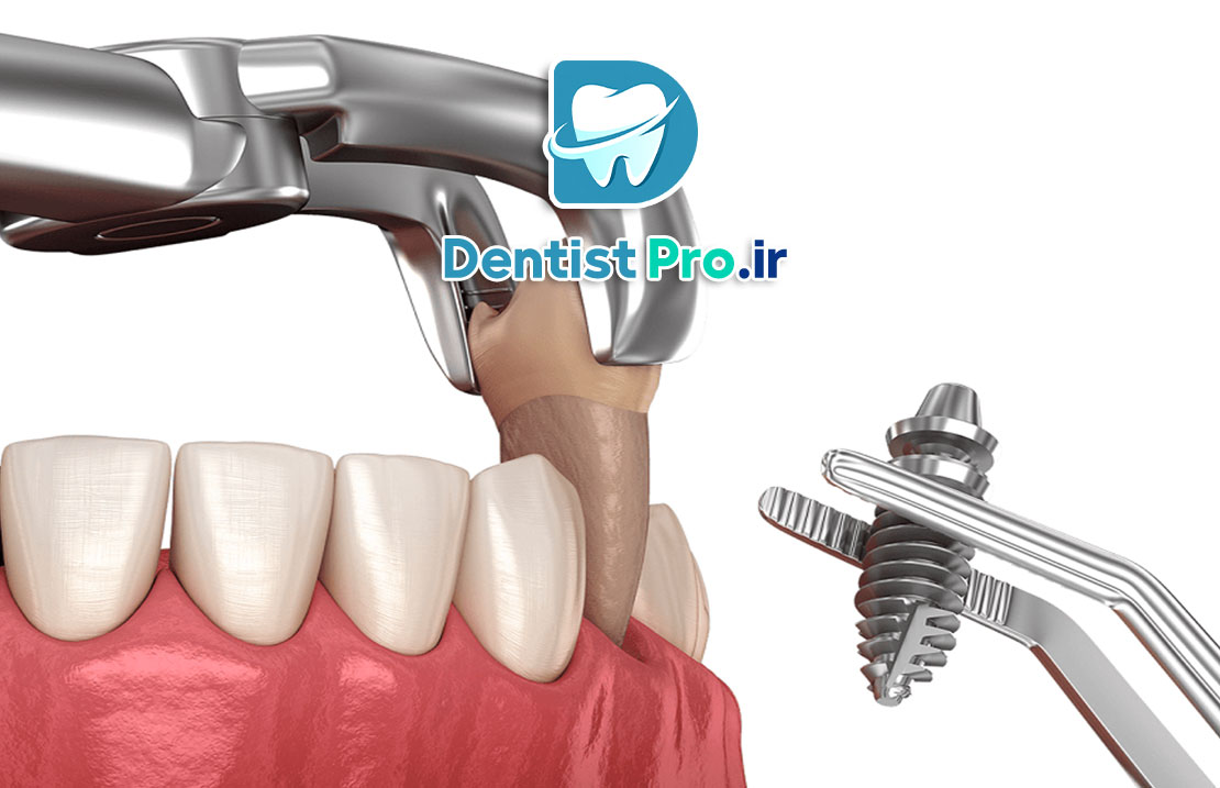 ایمپلنت فوری بعد از کشیدن دندان