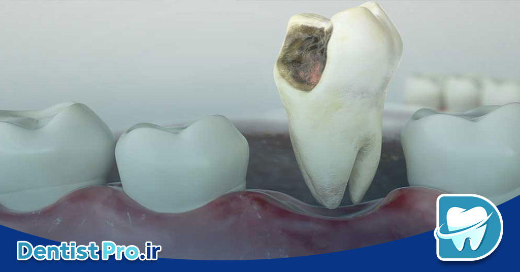 آیا باید دندان عفونی را بکشیم؟ هرآنچه باید درباره کشیدن دندان عفونی بدانید (از زبان یک متخصص)