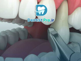 آیا باید دندان عفونی را بکشیم؟ هرآنچه باید درباره کشیدن دندان عفونی بدانید (از زبان یک متخصص) 46 آیا باید دندان عفونی را بکشیم؟ هرآنچه باید درباره کشیدن دندان عفونی بدانید (از زبان یک متخصص)