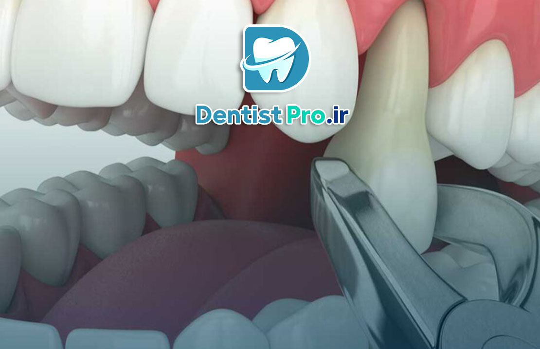 آیا باید دندان عفونی را بکشیم؟ هرآنچه باید درباره کشیدن دندان عفونی بدانید (از زبان یک متخصص)