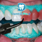 بلیچینگ دندان بدون درد