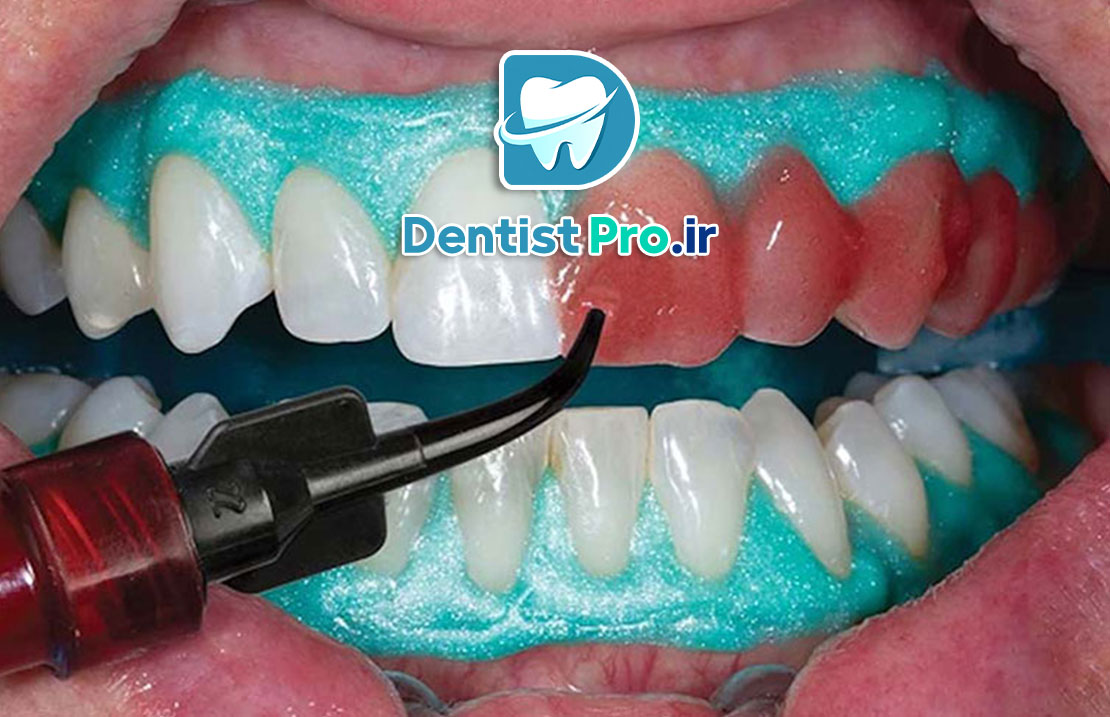 بلیچینگ دندان بدون درد