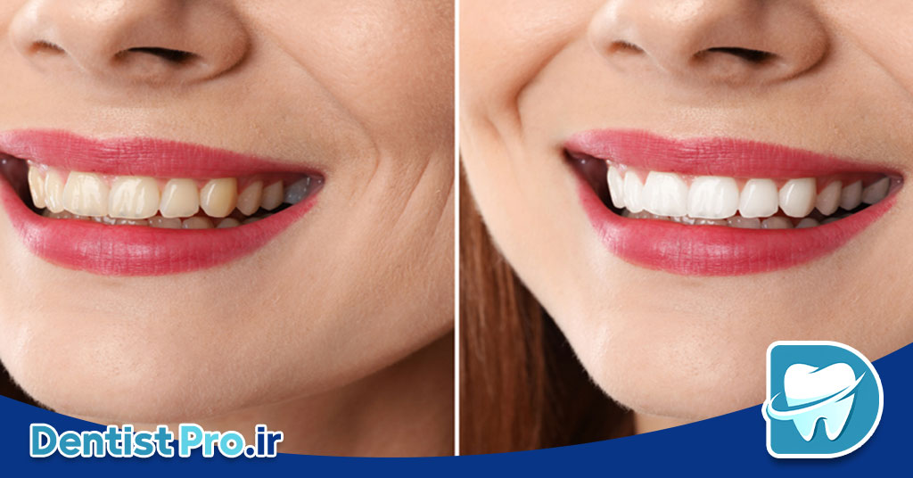 بلیچینگ دندان بدون درد