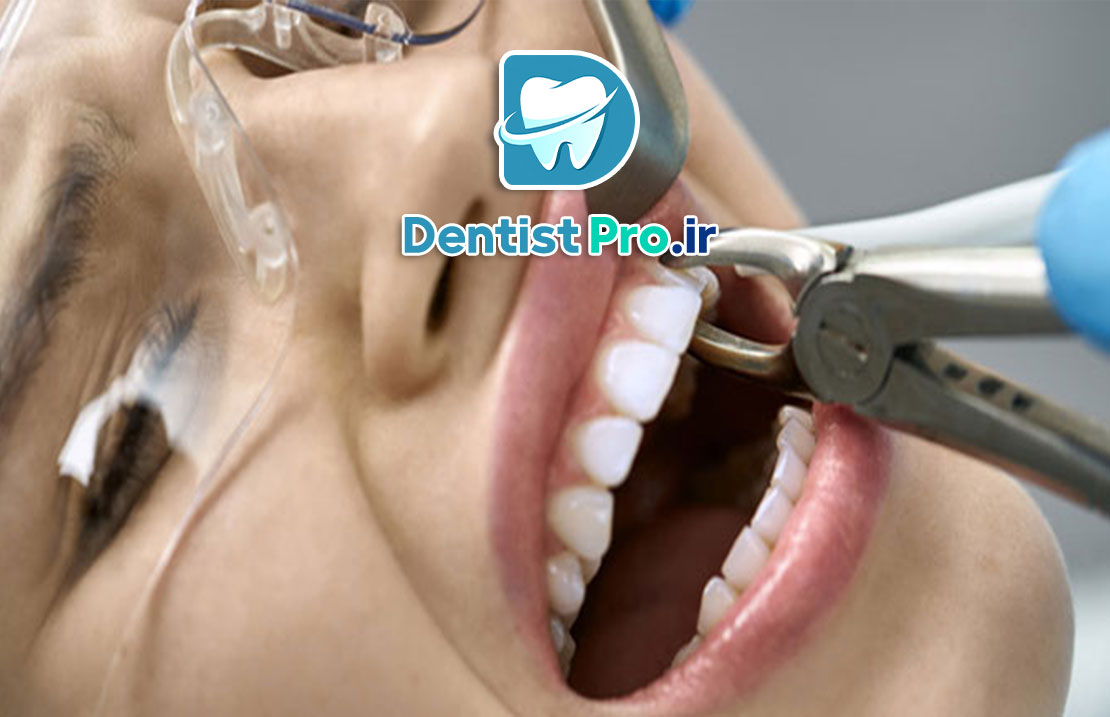 کشیدن دندان بدون درد در کلینیک مدرن: تجربه‌ای نوین در درمان‌های دندان‌پزشکی