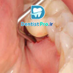 عفونت دندان بدون درد: تهدید خاموش سلامت دهان