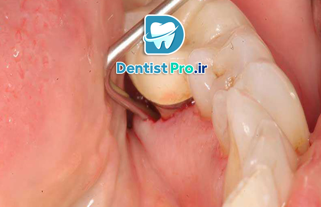 عفونت دندان بدون درد: تهدید خاموش سلامت دهان 25 عفونت دندان بدون درد: تهدید خاموش سلامت دهان