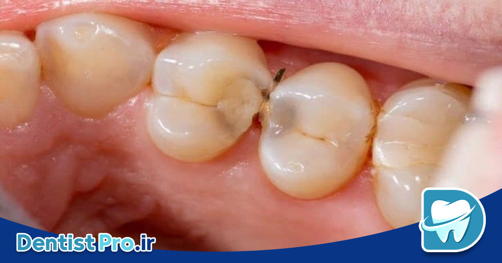 عفونت دندان بدون درد: تهدید خاموش سلامت دهان 27 عفونت دندان بدون درد: تهدید خاموش سلامت دهان