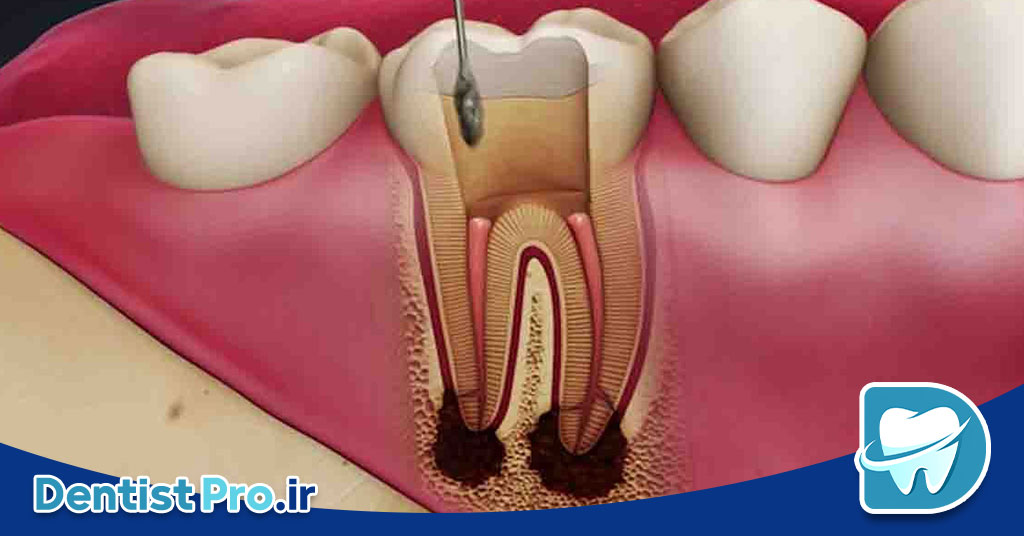 عصب کشی دندان عقب+مراحل آن چیست؟