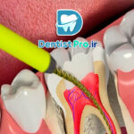 عصب کشی دندان عقب+مراحل آن چیست؟