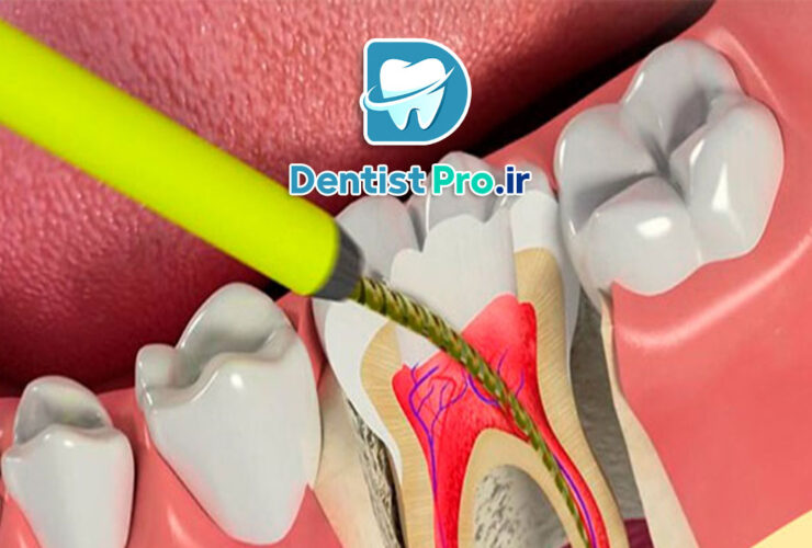 عصب کشی دندان عقب+مراحل آن چیست؟ 34 عصب کشی دندان عقب+مراحل آن چیست؟