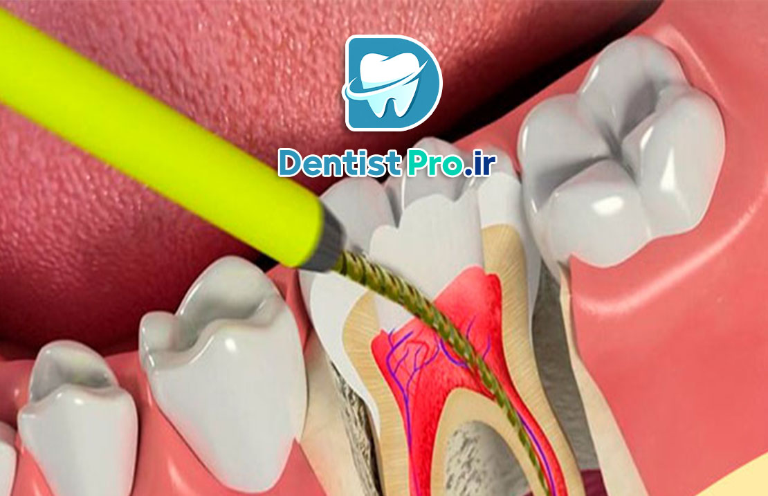 عصب کشی دندان عقب+مراحل آن چیست؟