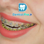 ارتودنسی سریع برای نوجوانان