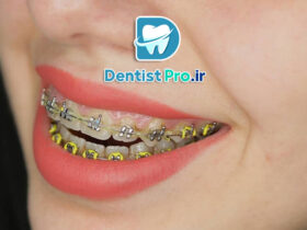 ارتودنسی سریع برای نوجوانان