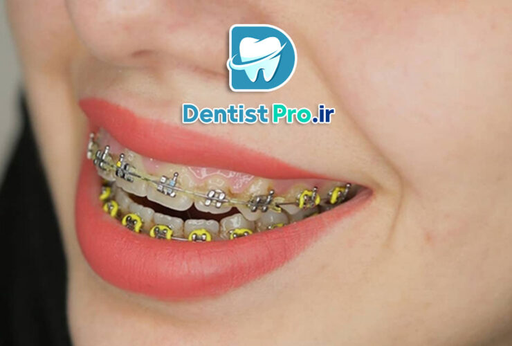 ارتودنسی سریع برای نوجوانان 34 ارتودنسی سریع برای نوجوانان