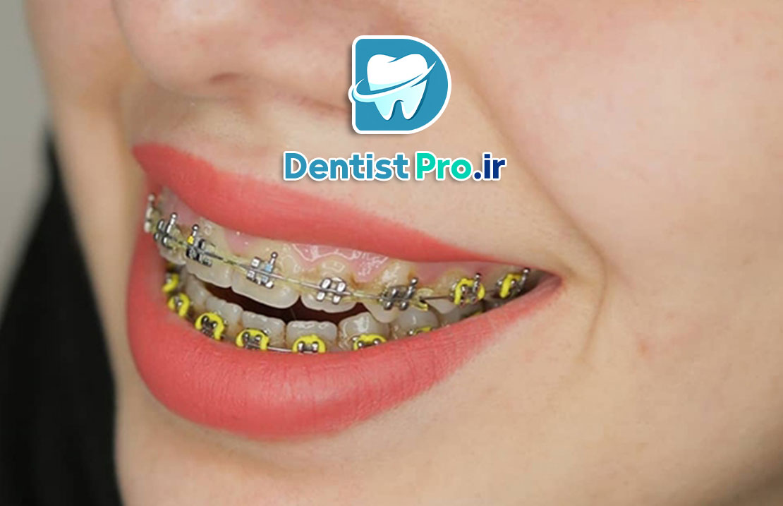 ارتودنسی سریع برای نوجوانان