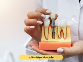 معرفی بهترین برندهای ایمپلنت دندان (1404) + رتبه‌بندی + مقایسه سوئیسی تا کره‌ای
