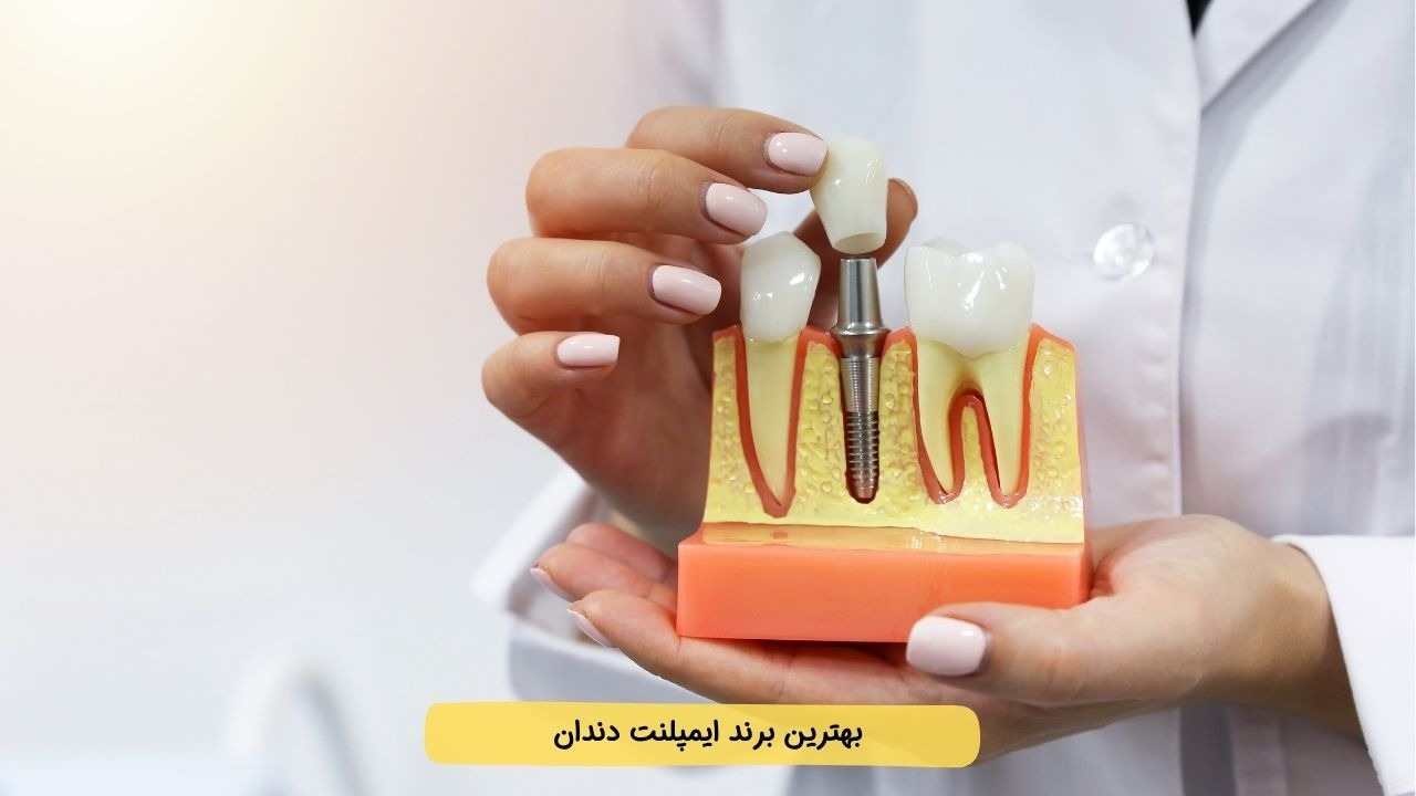 معرفی بهترین برندهای ایمپلنت دندان (1404) + رتبه‌بندی + مقایسه سوئیسی تا کره‌ای