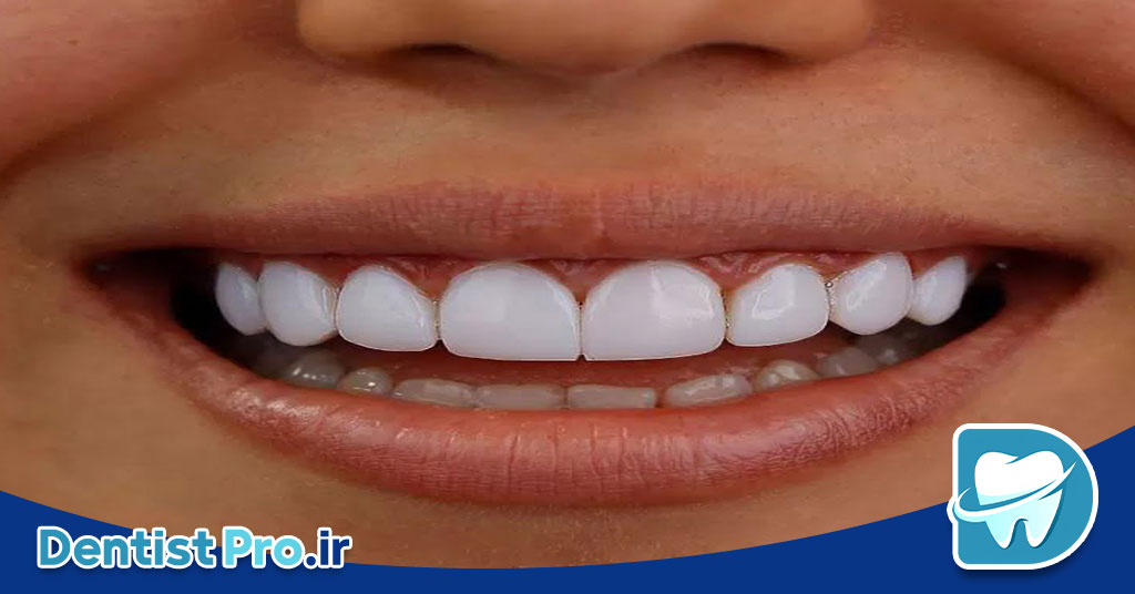فرم دهی دندان‌های جلو؛ راهنمایی جامع از زبان یک متخصص دندانپزشک