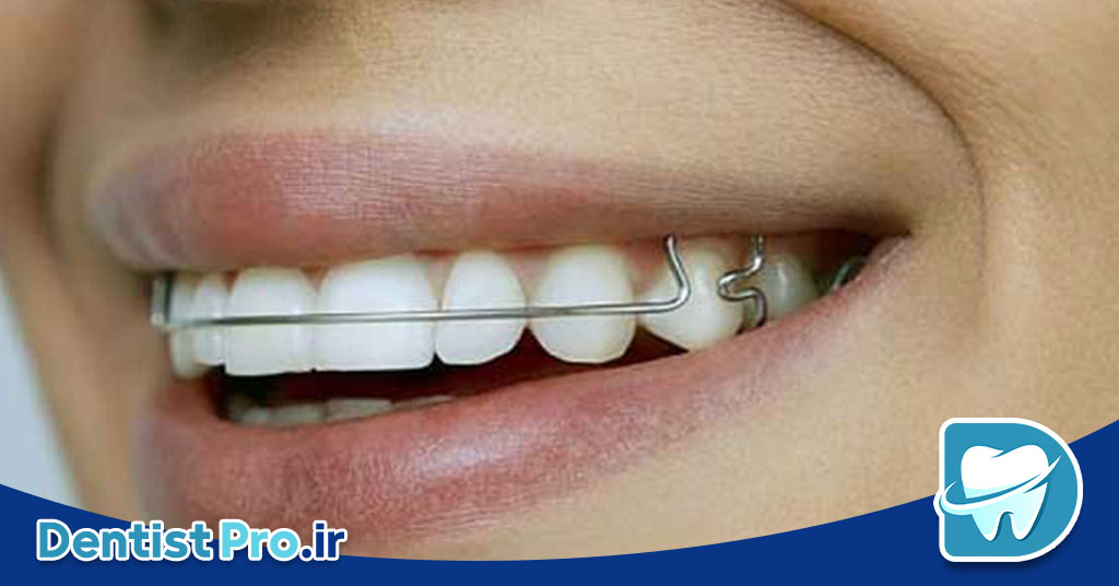 اصلاح لبخند بدون ارتودنسی+ 5 روش موثر 29 اصلاح لبخند بدون ارتودنسی+ 5 روش موثر