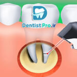 نشانه های عفونت ریشه دندان که نباید آنها را نادیده بگیرید!