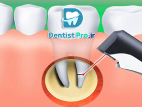 نشانه های عفونت ریشه دندان که نباید آنها را نادیده بگیرید! 57 نشانه های عفونت ریشه دندان که نباید آنها را نادیده بگیرید!