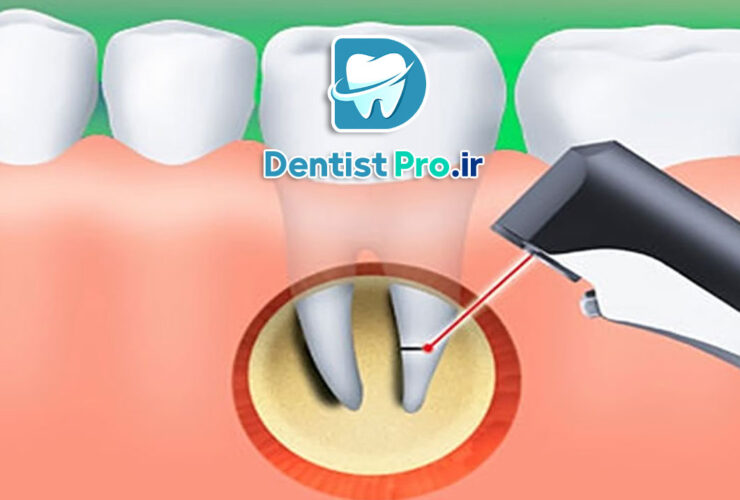 نشانه های عفونت ریشه دندان که نباید آنها را نادیده بگیرید! 41 نشانه های عفونت ریشه دندان که نباید آنها را نادیده بگیرید!