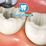 پر کردن دندان با مواد سفید