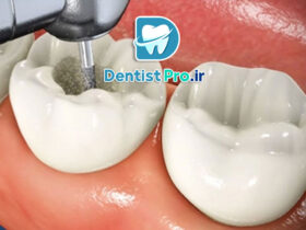 پر کردن دندان با مواد سفید 46 پر کردن دندان با مواد سفید