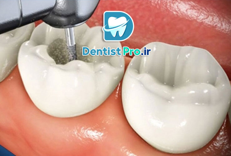 پر کردن دندان با مواد سفید