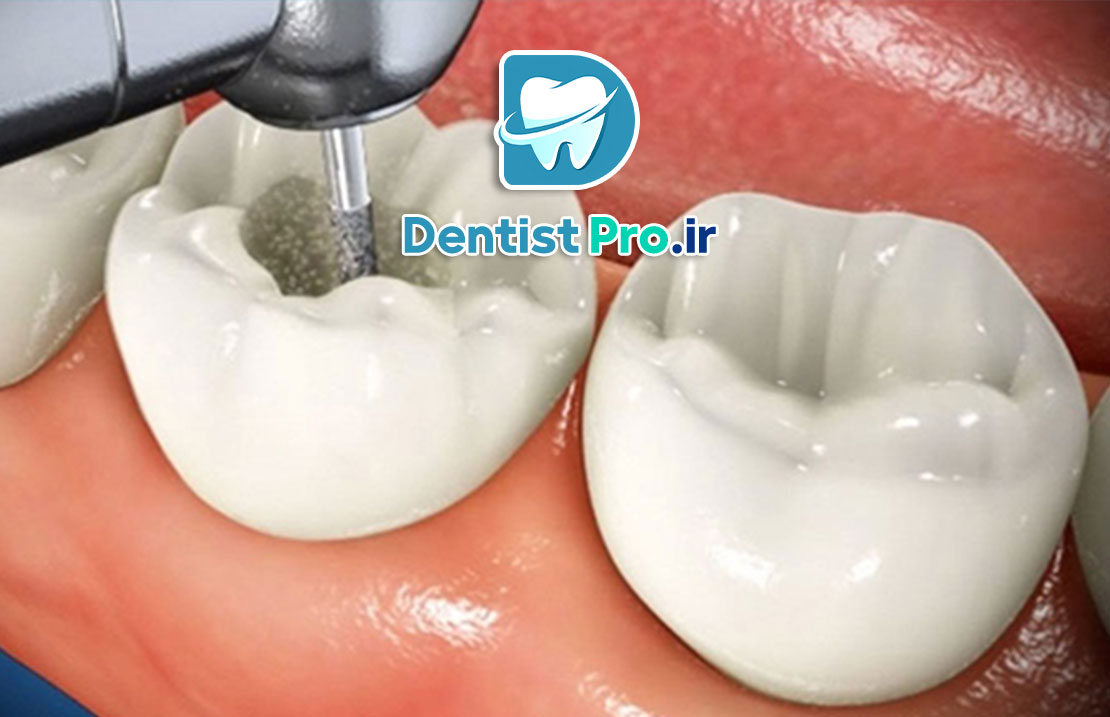 پر کردن دندان با مواد سفید
