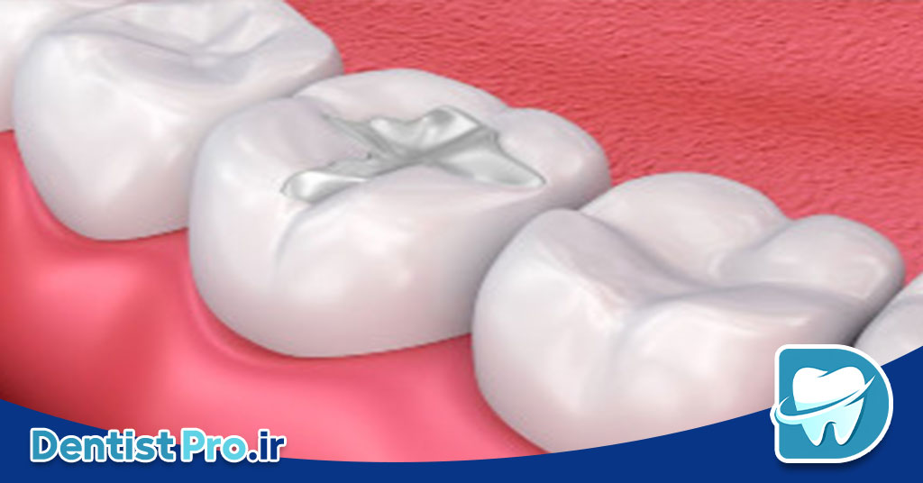 پر کردن دندان با مواد سفید