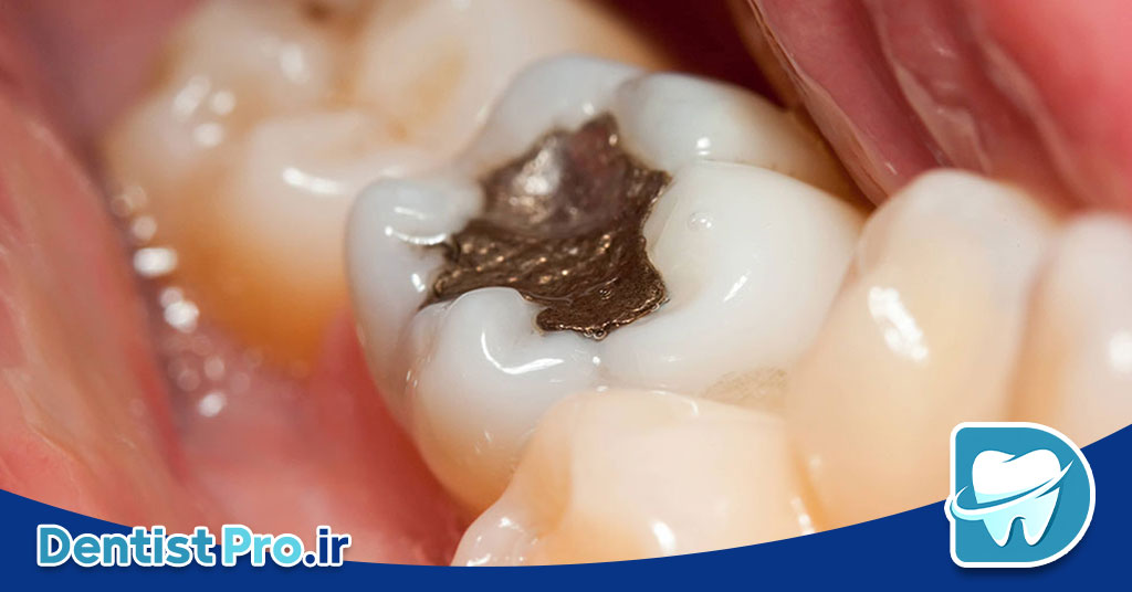 بهترین نوع پرکردگی برای دندان پوسیده چیست؟